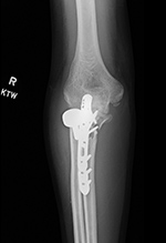 Right elbow radial head prosthesis frontal view